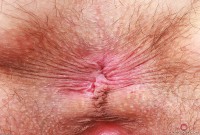 ATK hairy  in young and hairy