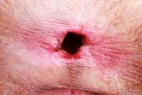 ATK hairy  in young and hairy