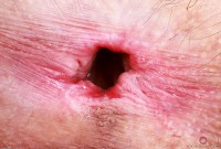 ATK hairy  in young and hairy