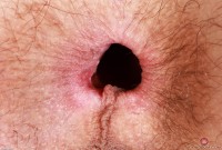 ATK hairy  in young and hairy