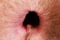 ATK hairy  in young and hairy