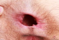 ATK hairy  in young and hairy