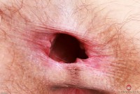 ATK hairy  in young and hairy