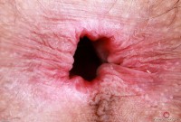 ATK hairy  in young and hairy