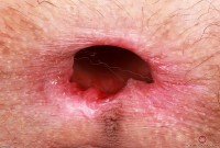 ATK hairy  in young and hairy