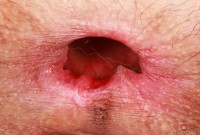 ATK hairy  in young and hairy