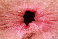 ATK hairy  in young and hairy