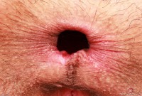 ATK hairy  in young and hairy