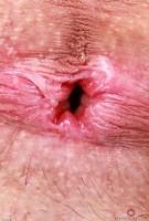 ATK hairy  in young and hairy