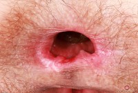 ATK hairy  in young and hairy