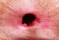 ATK hairy  in young and hairy