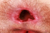 ATK hairy  in young and hairy