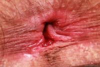 ATK hairy  in young and hairy