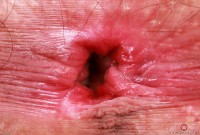 ATK hairy  in young and hairy