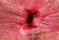 ATK hairy  in young and hairy