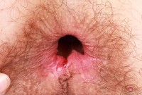 ATK hairy  in young and hairy