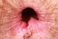 ATK hairy  in young and hairy