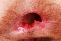 ATK hairy  in young and hairy