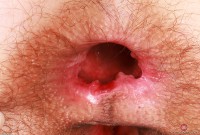 ATK hairy  in young and hairy