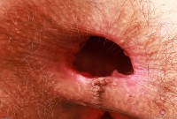 ATK hairy  in young and hairy