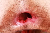 ATK hairy  in young and hairy