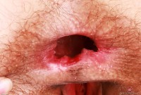 ATK hairy  in young and hairy