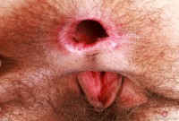 ATK hairy  in young and hairy