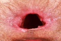 ATK hairy  in young and hairy