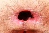 ATK hairy  in young and hairy