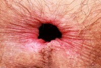 ATK hairy  in young and hairy