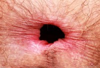 ATK hairy  in young and hairy