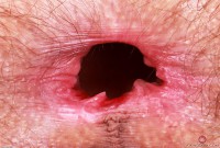 ATK hairy  in young and hairy