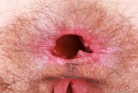 ATK hairy  in young and hairy