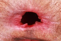 ATK hairy  in young and hairy