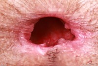 ATK hairy  in young and hairy