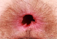 ATK hairy  in young and hairy