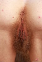 ATK hairy  in mature and hairy