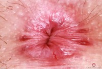 ATK hairy  in young and hairy