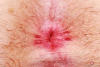 ATK hairy  in young and hairy