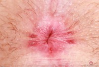 ATK hairy  in young and hairy