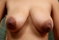 ATK hairy  in mature and hairy