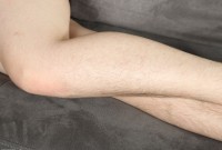 ATK hairy  in young and hairy