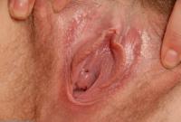 ATK hairy  in young and hairy