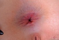 ATK hairy  in young and hairy