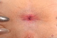 ATK hairy  in young and hairy