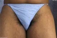 ATK hairy  in exotic and hairy