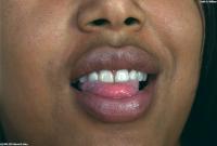 ATK hairy  in exotic and hairy