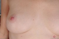 ATK hairy  in mature and hairy