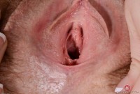 ATK hairy  in mature and hairy