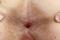 ATK hairy  in young and hairy